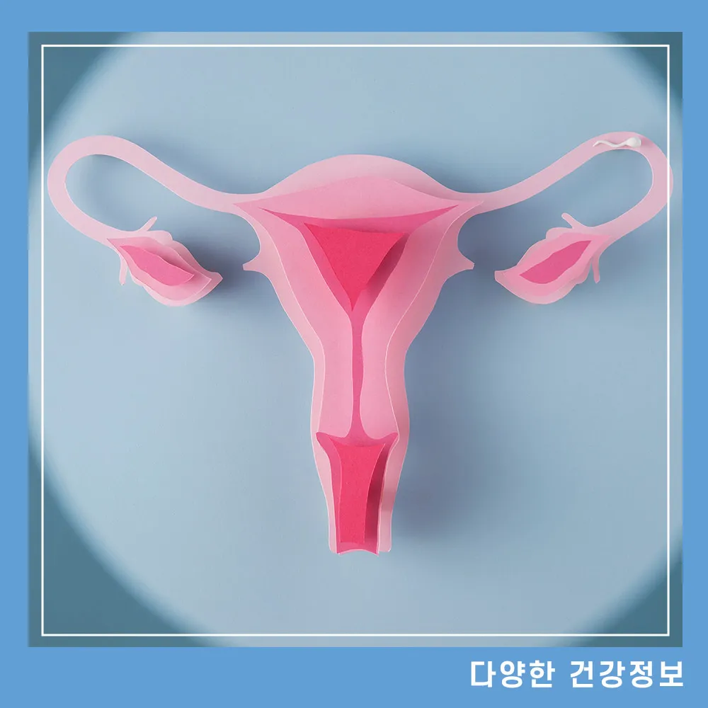 다낭성-난소-증후군-치료-증상