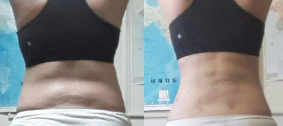 복부지방흡입 후기