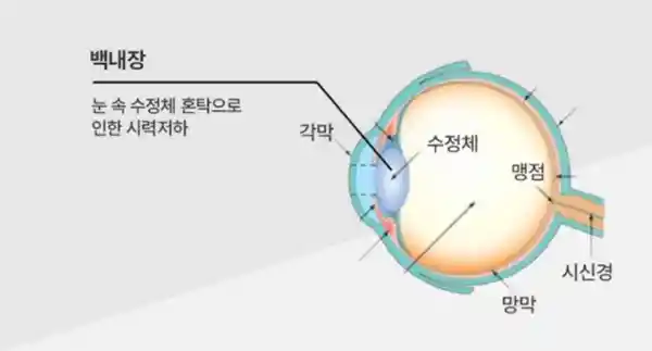 백내장 사진