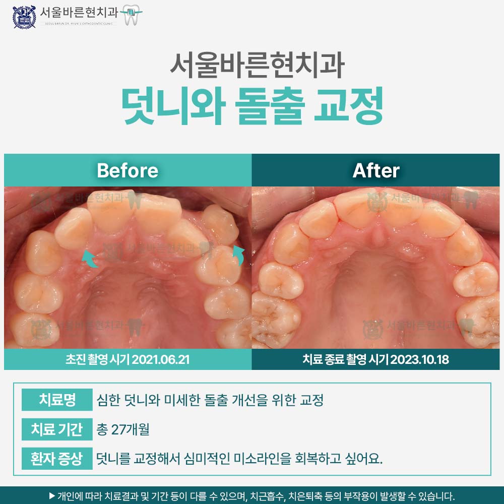 해운대돌출입교정