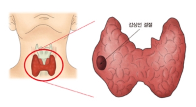 갑상선 이미지