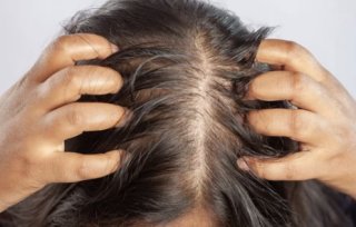 지루성 피부염 증상