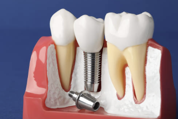 임플란트 시술과정