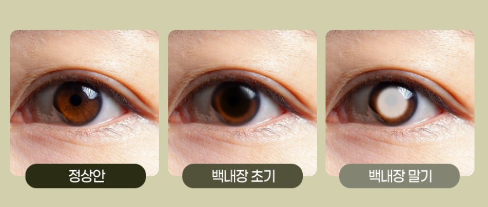 백내장과 노안