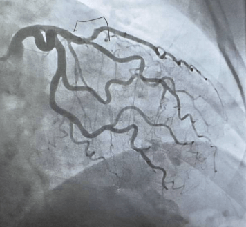 협심증 전조증상 총정리｜심근경색과의 차이점
