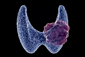 갑상선-결절-증상