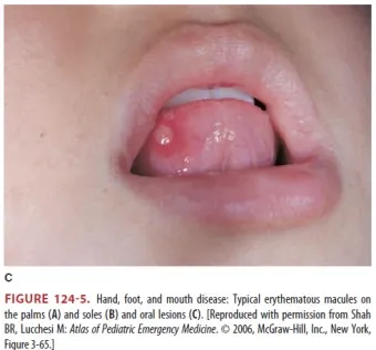 수족구병 증상과 예방 조치 방법 모음_18