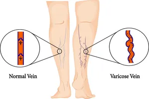 하지-정맥류-수술비용