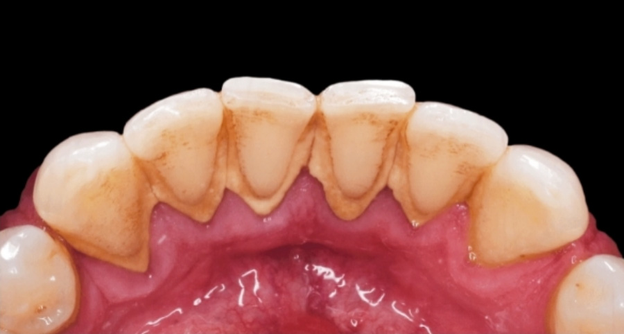 치아의 안쪽에 침에서 분비가 된 석회분이 부착해서 굳어져 생긴 물질인 치석을 찍은 사진