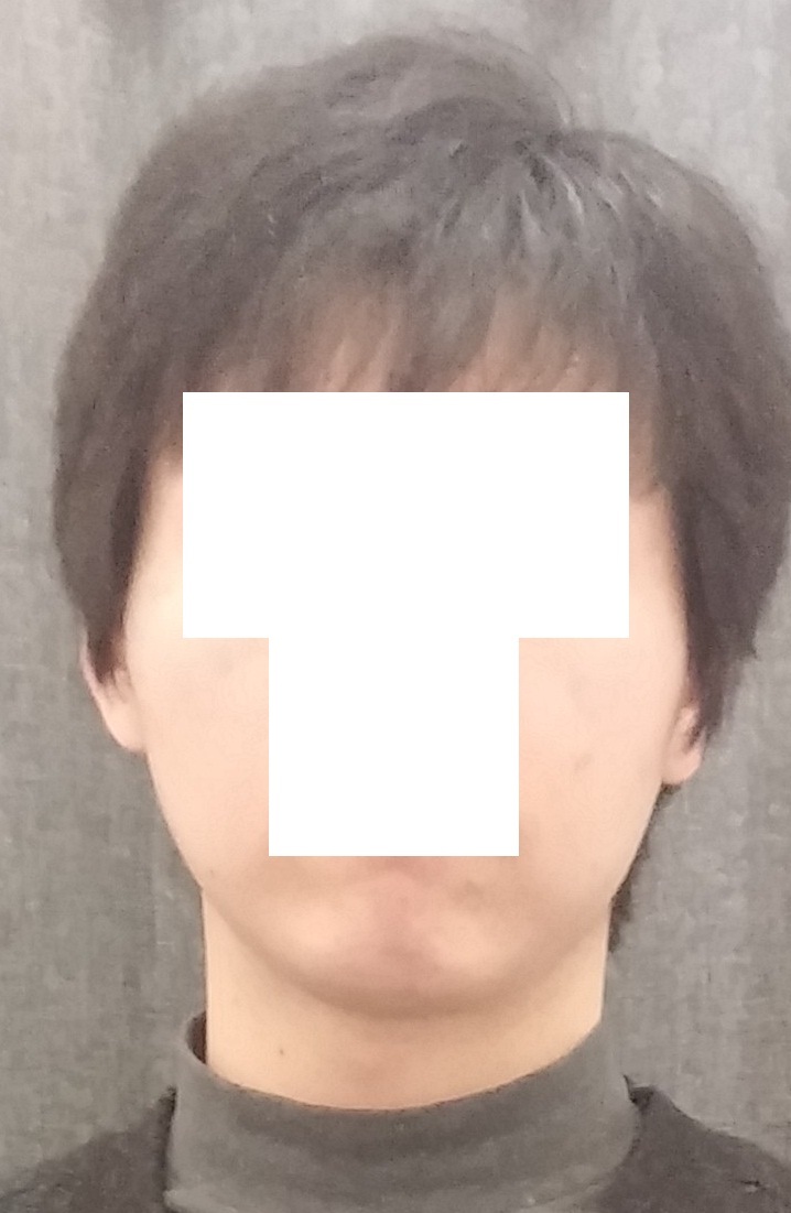 얼굴 지방흡입 후기