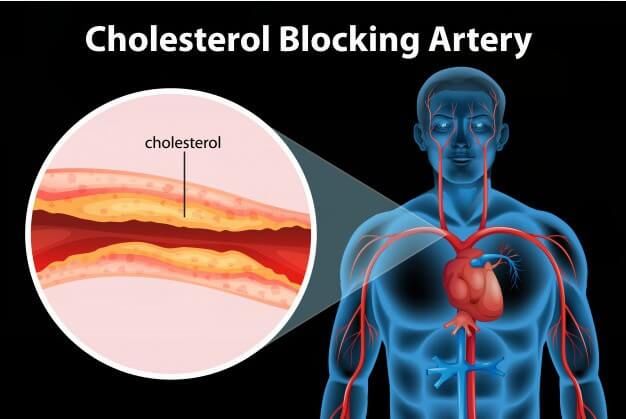 저밀도 콜레스테롤 정상수치