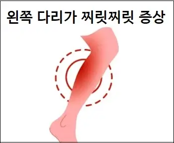 왼쪽 다리가 찌릿찌릿 증상 이해