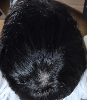 정수리가 아픈 이유와 완화하는 방법_2