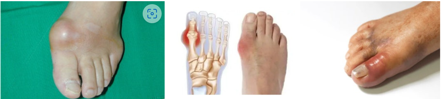 통풍에 좋은 음식 vs 피해야 할 음식