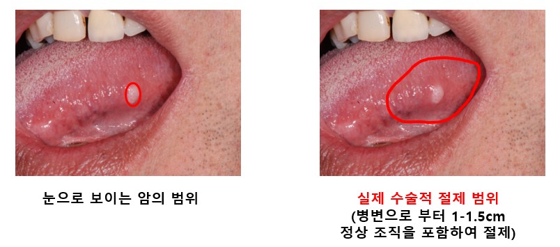 절제술