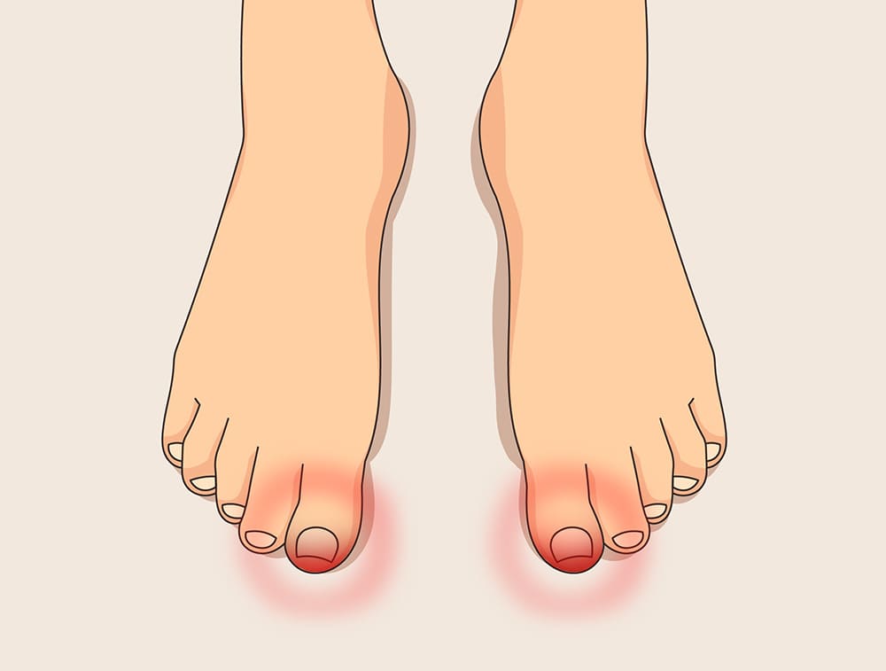 발톱무좀
