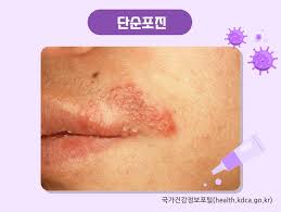 입술 포진 빨리 낫는법