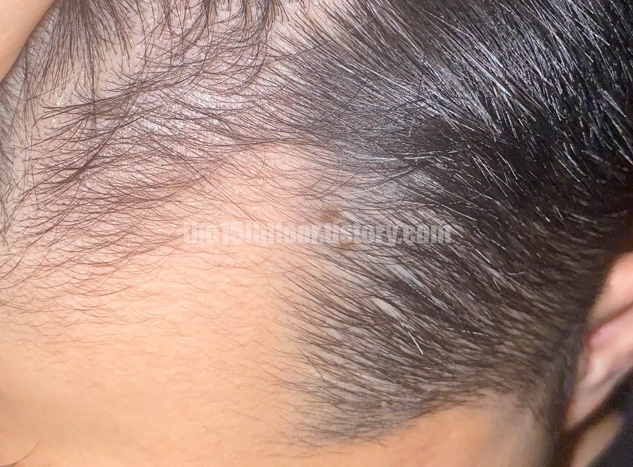 로게인폼 3개월 사용 후기 (사용 후)