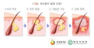 여드름 발생 과정