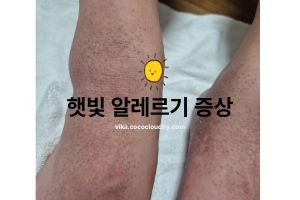 햇빛 알레르기 증상