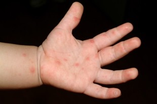 수족구, 수족구 증상, 수족구 초기 증상, 수족구 예방, 수족구 대처방법, 수족구 열, 수족구 수포