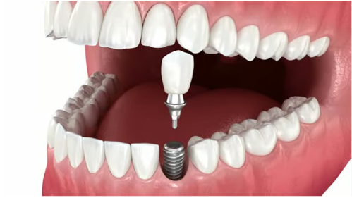 어금니 임플란트 종류