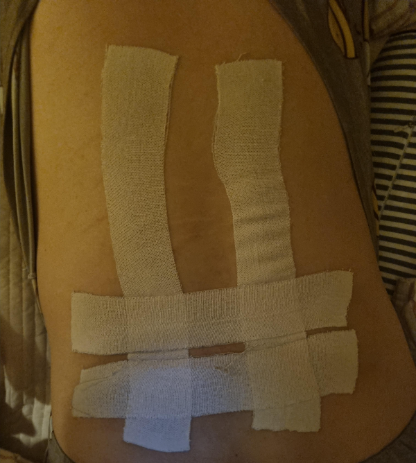 허리디스크 터짐