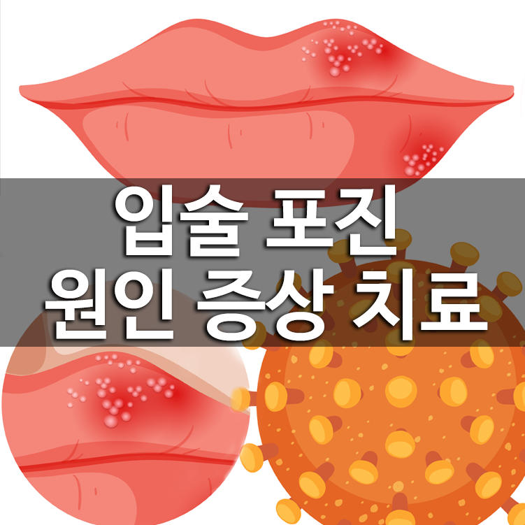 입술포진
