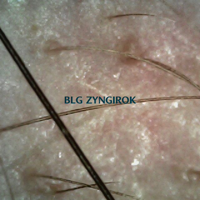 탈모 극복 프로젝트 - 오른쪽 M자 부위 두피 모습이다.