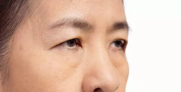 눈밑 꺼짐 없애는방법