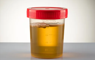 소변 사진/출처:어도비스톡