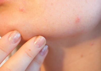 대상포진 진료과