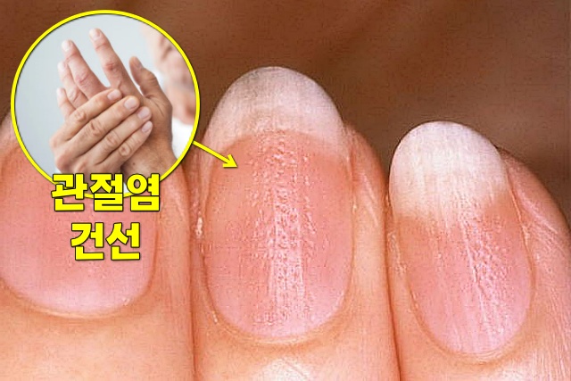 손톱이 울퉁불퉁 파임 건선 류마티스 관절염 초기증상, 원형탈모증, 손톱으로 보는 건강상태, 건강 팁줌 매일꿀정보