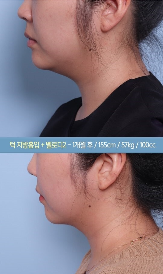 턱살지방흡입 후기