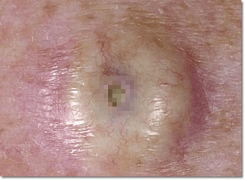 화농성 한선염 증상