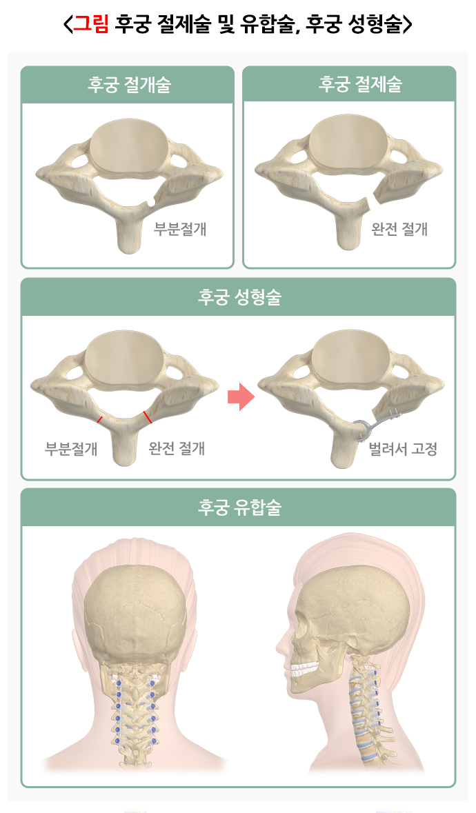 경추통증