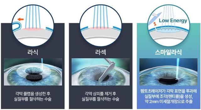 스마일라식 라섹 라식 비교 차이점