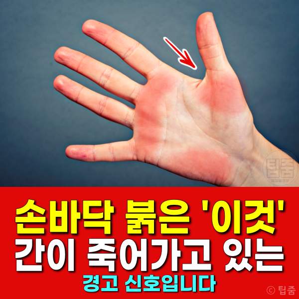 간이 안좋으면 나타나는 증상,간경화 증상,간이안좋은증상,팁줌