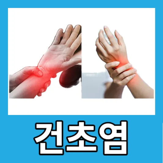손목 염증 통증 엄지손가락 인대 통증 손목 건초염 보호대 치료 수술