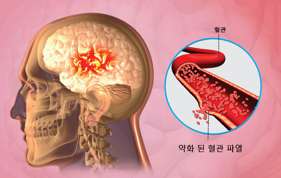 뇌졸증