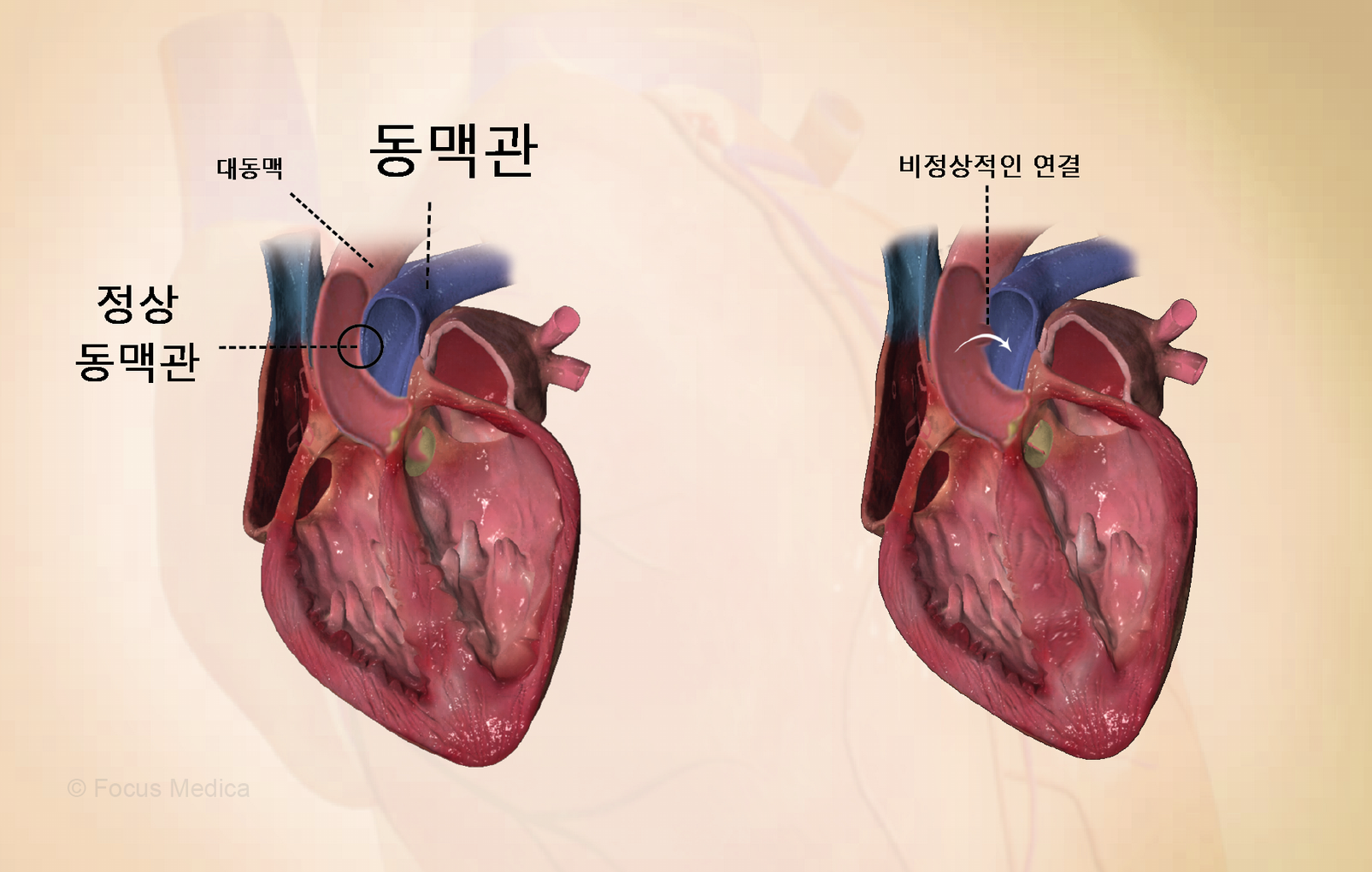 동맥관 개존증