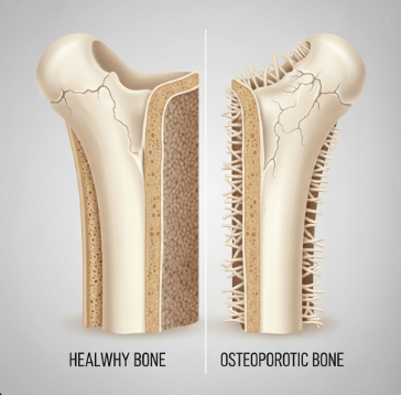 골다공증 약 종류와 효과 비교1