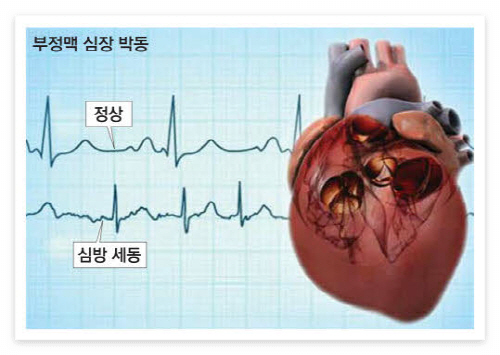 부정맥