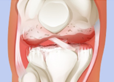 무릎관절염-4기