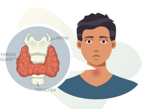 갑상선 기능저하증 증상 좋은 음식 수치 등 알아보기 (24년 Ver)
