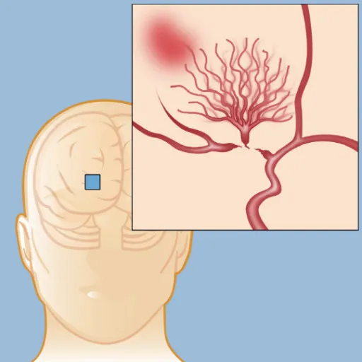 모야모야병 증상 및 원인과 장애등급 여부 알아보기