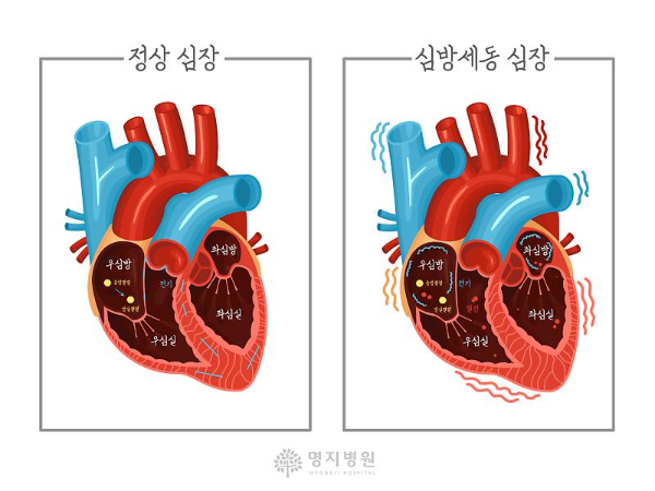 부정맥-심방세동-뇌졸중-뇌경색-위험-약물-수술-치료법