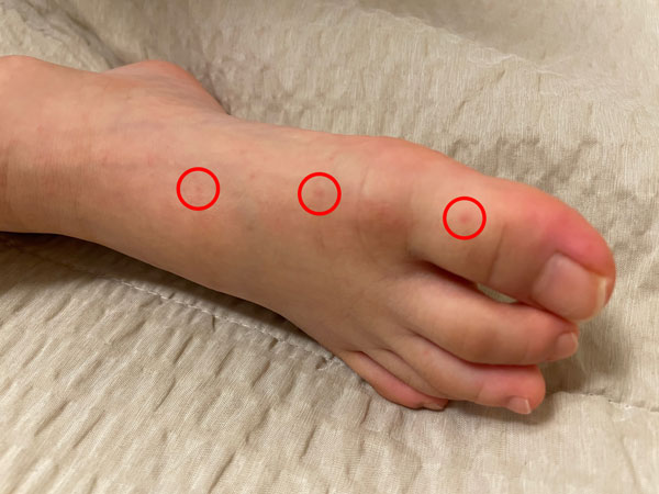 발등에도 수족구 발진