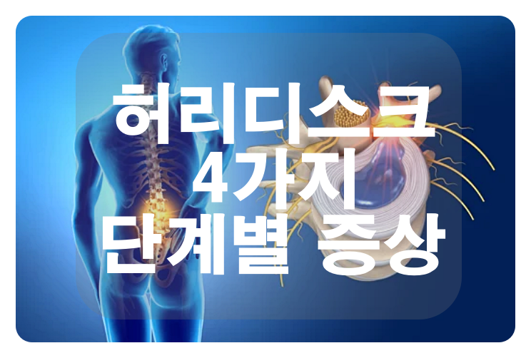 허리디스크 치료의 선택과 4가지 단계별 증상에 대하여