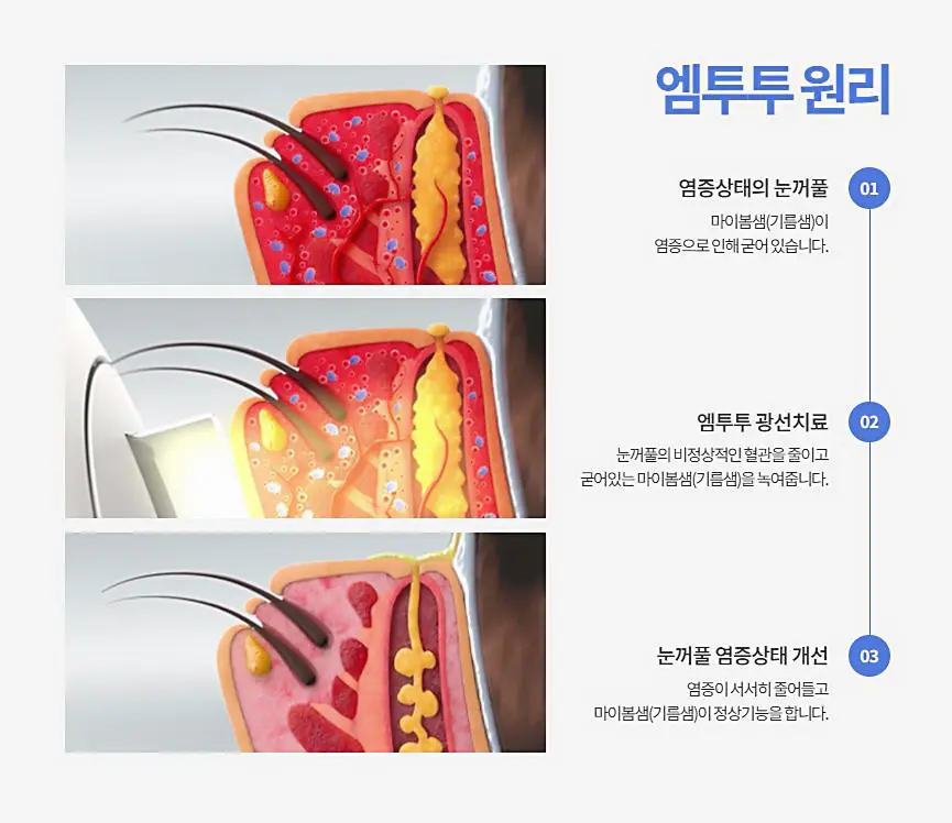 안구건조증-치료-M22-IPL-레이저-원리